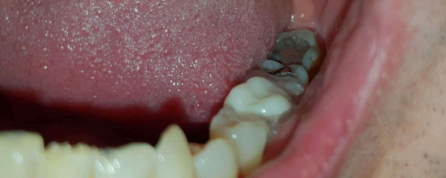 Fertige Denticor-Versorgung eines fehlenden Backenzahns — Keramikkrone fixiert