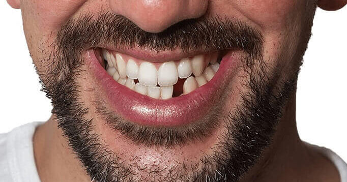 Denticor-Set — Keramikzähne in der Verpackung