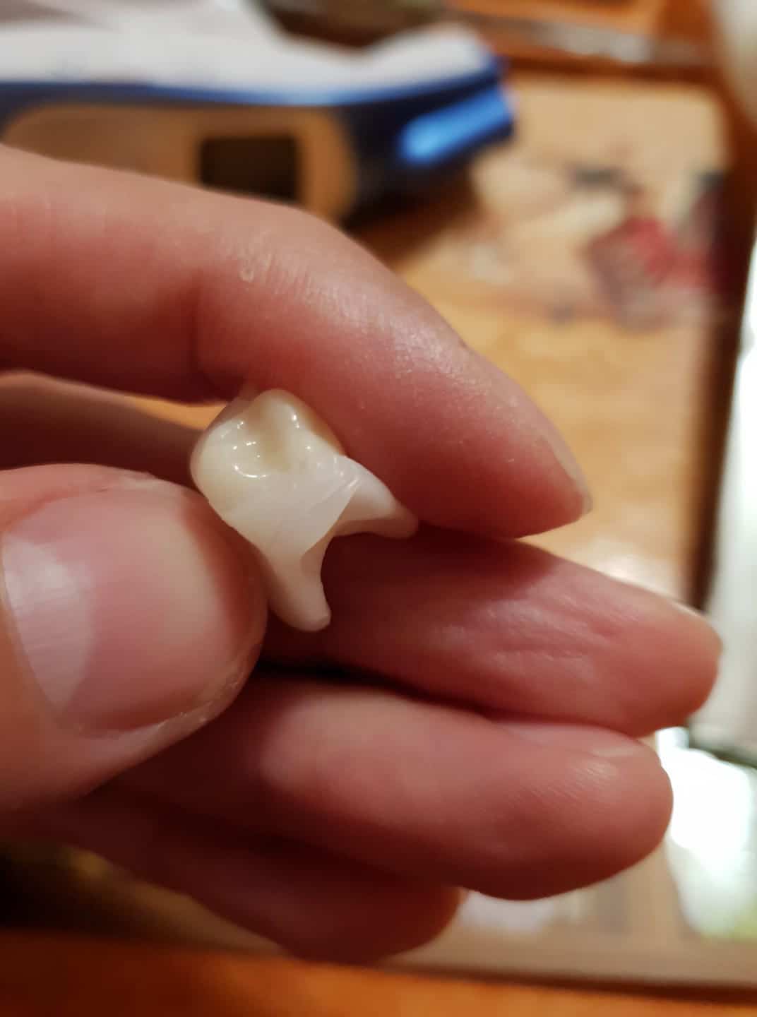 Finálna Zahnersatz Denticor po Monatoch vývoja
