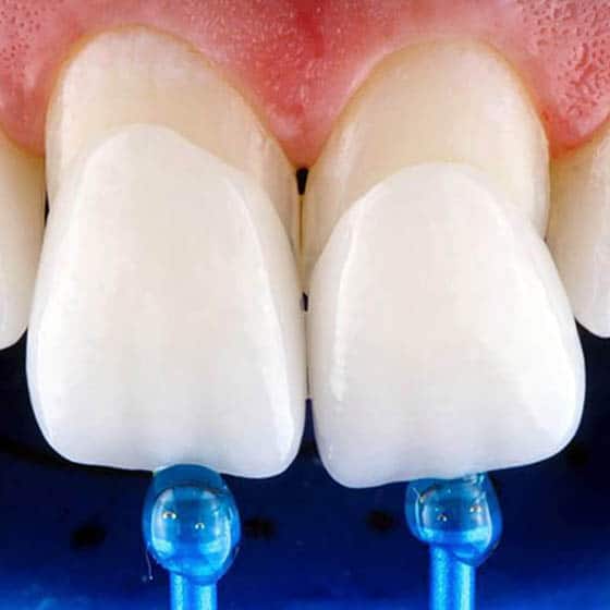 Denticor Veneers — ästhetische Abdeckung der Frontzähne
