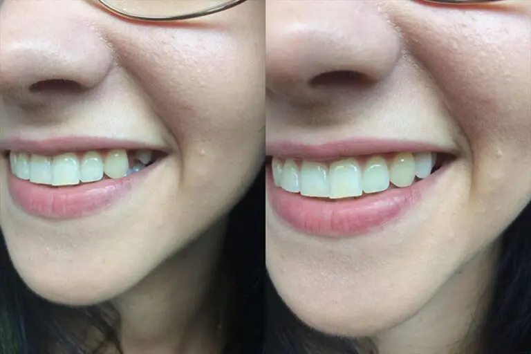 Denticor — vorher und nachher mit provisorischem Zahnersatz