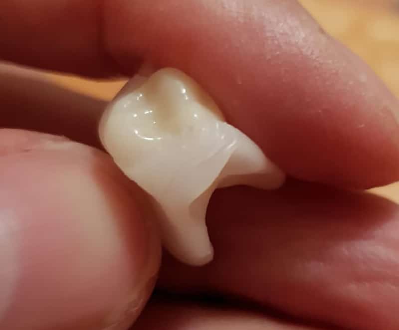 Keramická korunka mit DentiFlex Brückeom — makro detail