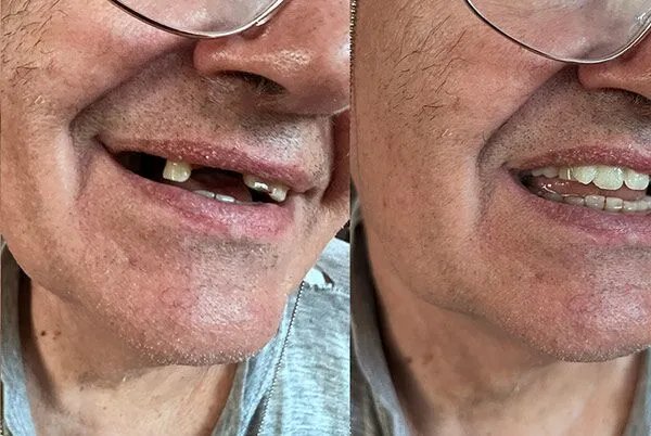 Zahnlücke geschlossen — Vorher/Nachher Kundenfoto
