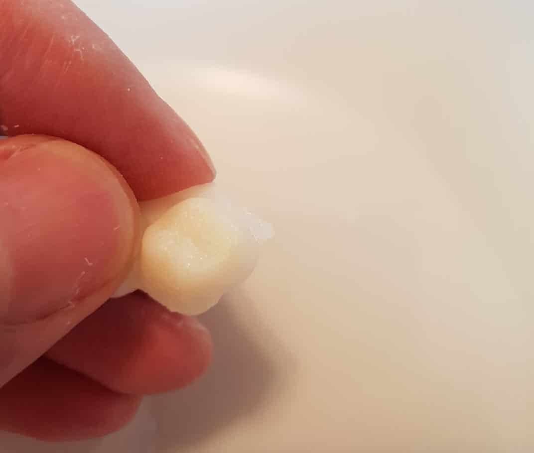 Erster Prototyp des Denticor Zahnersatzes