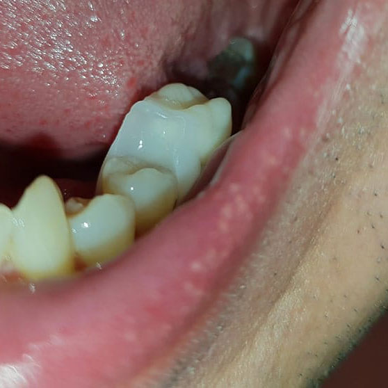 Detail eines eingesetzten Denticor-Zahns am unteren Backenzahn