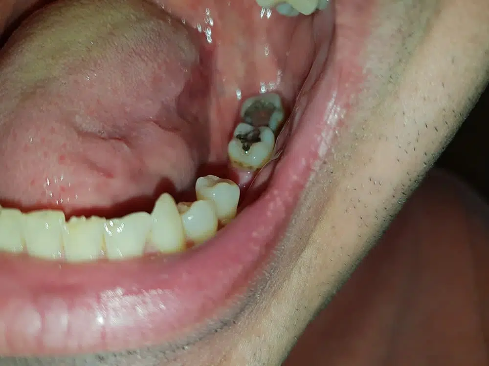 Lücke am unteren Backenzahn vor dem Einsetzen von Denticor