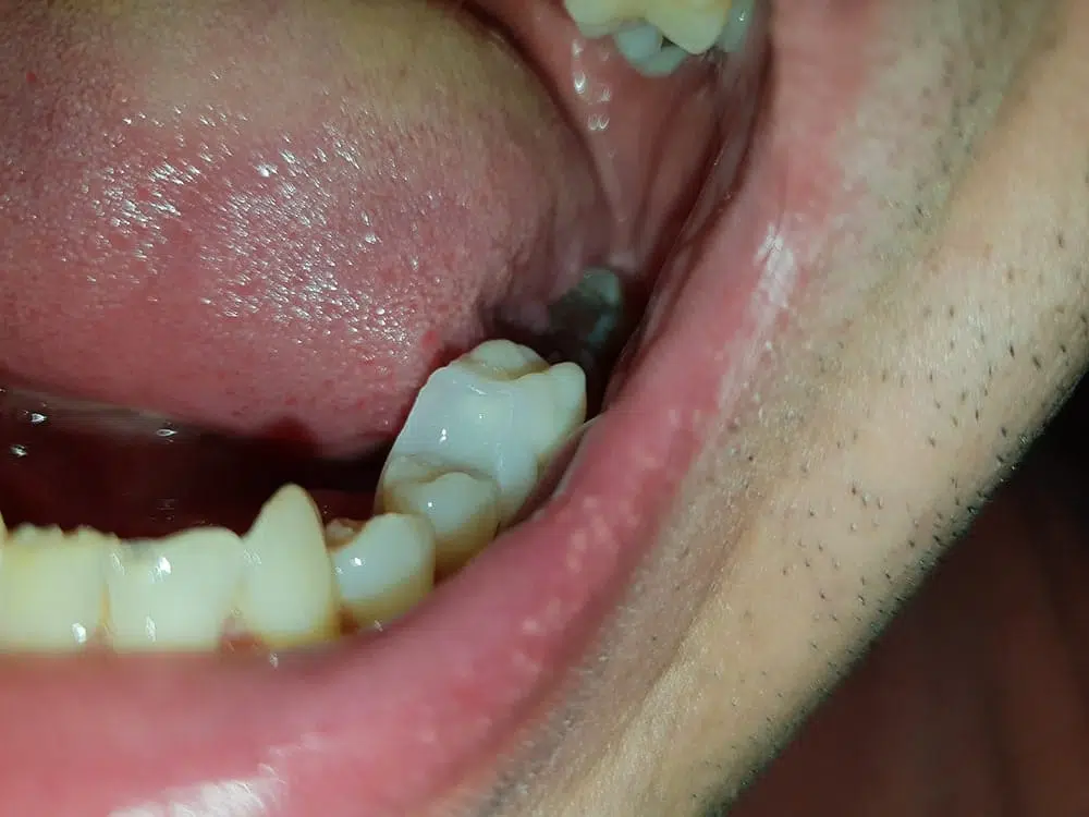 Unterer Backenzahn mit eingesetztem Denticor-Zahn