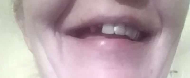 Fehlender oberer Vorderzahn vor Denticor