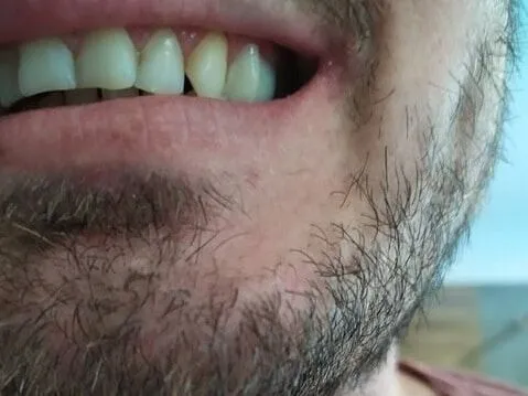 Seitliche Zahnlücke nach dem Einsetzen von Denticor