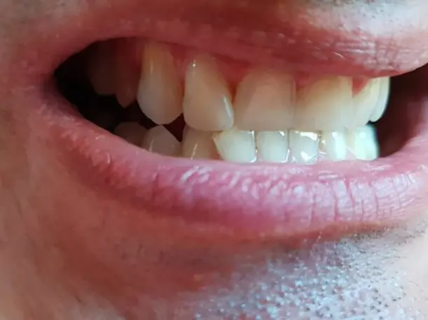 Vorderzähne nach dem Einsetzen von Denticor