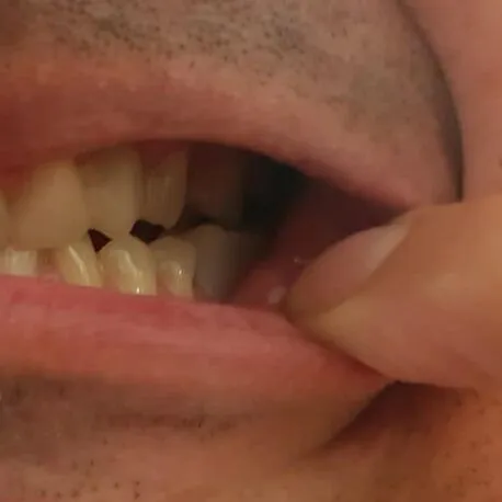 Seitlicher Zahn mit Denticor ergänzt, von der Seite gesehen