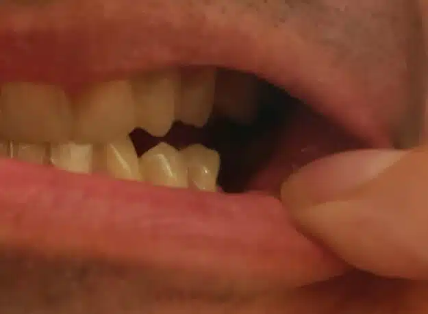 Seitliche Zahnlücke vor Denticor, von der Seite gesehen
