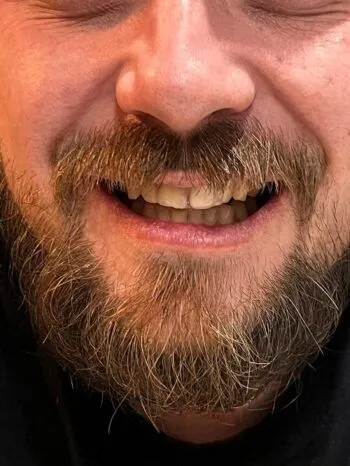 Vorderzahn nach dem Einsetzen von Denticor
