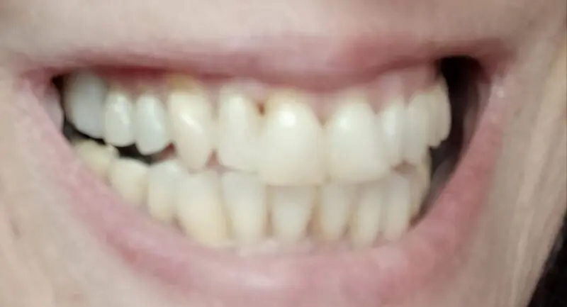 Dasselbe Lächeln mit eingesetztem Denticor-Vorderzahn