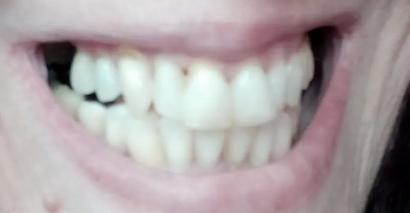 Lächeln mit einer Lücke am oberen Vorderzahn vor Denticor