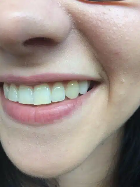 Lächeln mit eingesetztem Denticor