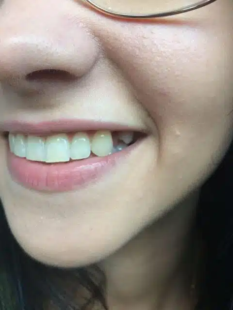 Vorderzahnlücke vor dem Einsetzen von Denticor