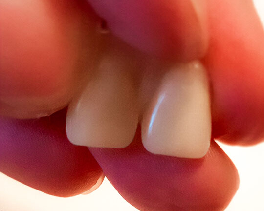 Zwei Denticor-Vorderzähne zwischen den Fingern gehalten