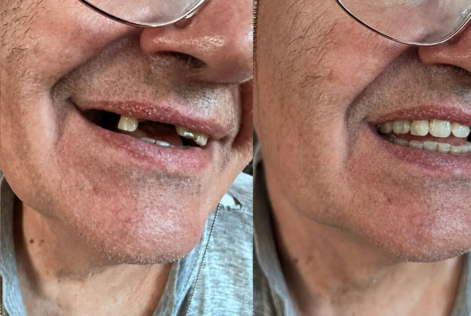 Vorher und nachher: mehrere obere Vorderzähne mit Denticor ergänzt