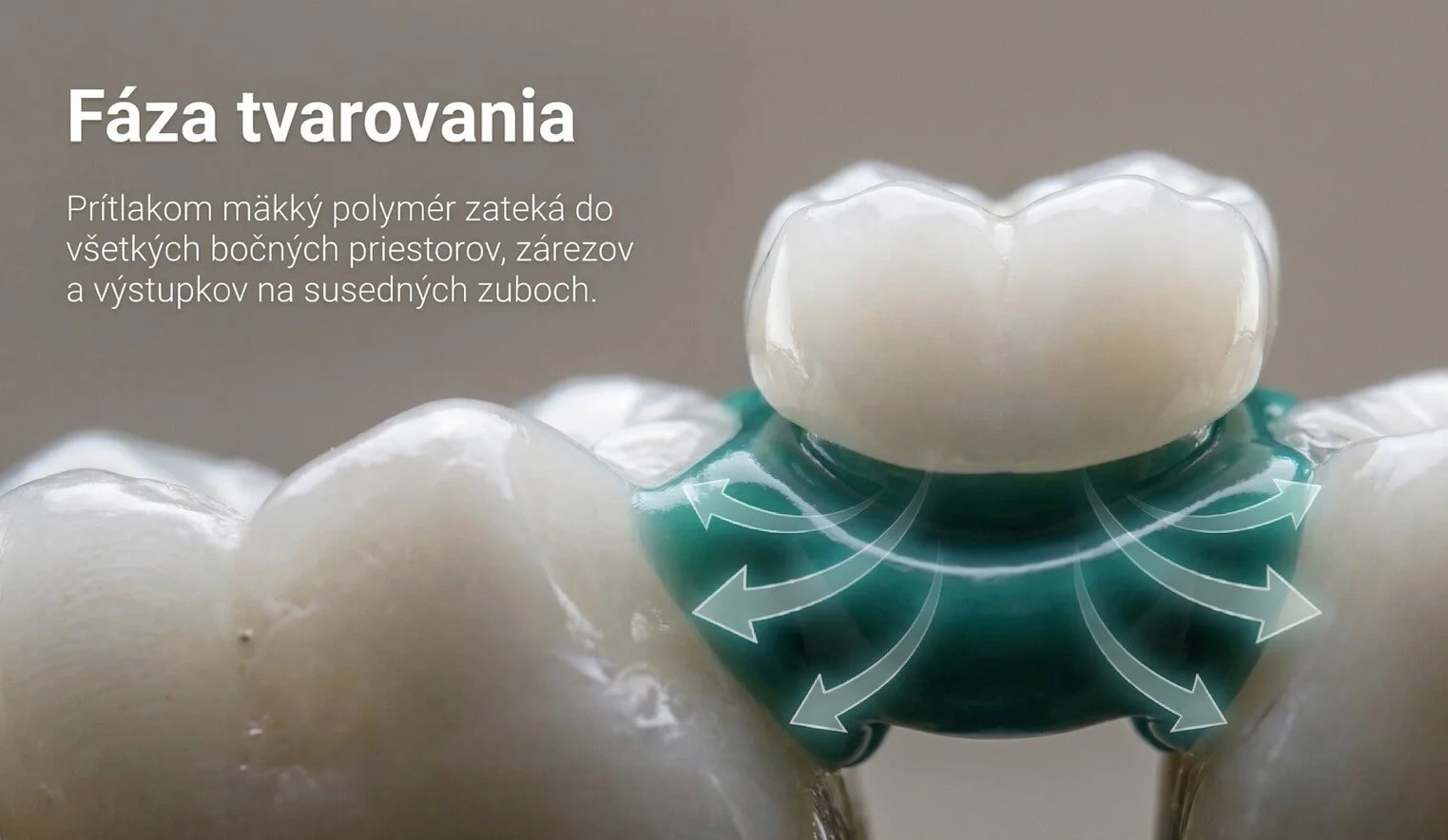 Formschluss — Denticor sitzt zwischen Nachbarzähnen, berührt nicht die Wunde nach Extraktion
