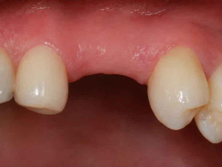 Bildverlauf Denticor – Schritt 1: provisorische Versorgung – ein unterer Eckzahn