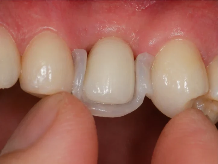 Bildverlauf Denticor – Schritt 3: provisorische Versorgung – ein unterer Eckzahn