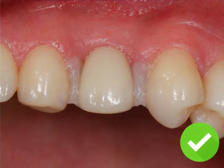 Bildverlauf Denticor – Schritt 4: provisorische Versorgung – ein unterer Eckzahn