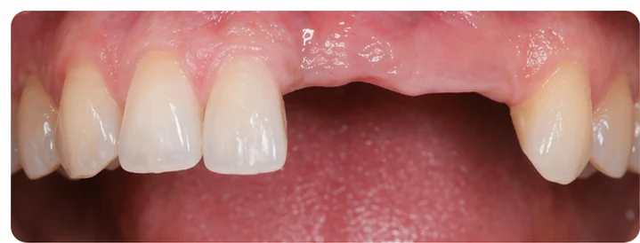 Bildverlauf Denticor — Schritt 1: provisorische Versorgung — zwei untere Prämolaren und ein Backenzahn