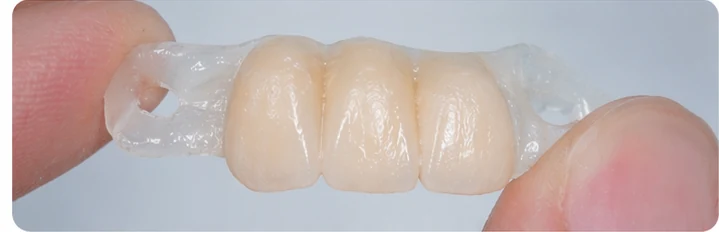 Bildverlauf Denticor — Schritt 3: provisorische Versorgung — zwei untere Prämolaren und ein Backenzahn