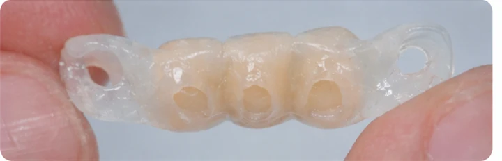 Bildverlauf Denticor — Schritt 4: provisorische Versorgung — zwei untere Prämolaren und ein Backenzahn