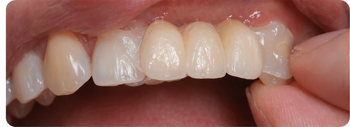 Bildverlauf Denticor — Schritt 5: provisorische Versorgung — zwei untere Prämolaren und ein Backenzahn