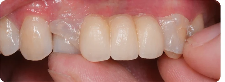 Bildverlauf Denticor — Schritt 6: provisorische Versorgung — zwei untere Prämolaren und ein Backenzahn