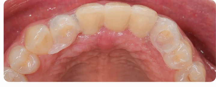 Bildverlauf Denticor — Schritt 7: provisorische Versorgung — zwei untere Prämolaren und ein Backenzahn