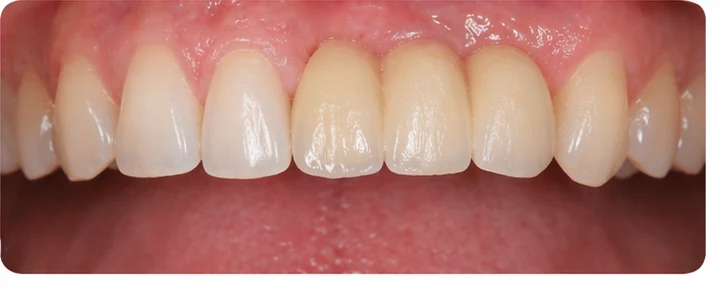 Bildverlauf Denticor — Schritt 8: provisorische Versorgung — zwei untere Prämolaren und ein Backenzahn