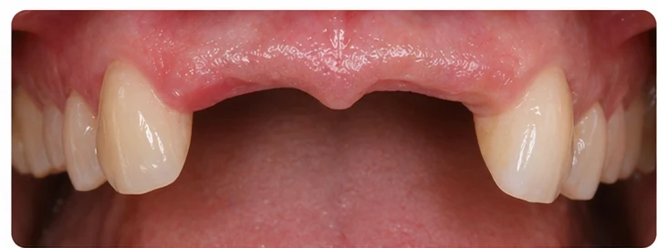 Bildverlauf Denticor – Schritt 1: provisorische Versorgung – drei untere Schneidezähne (beide mittleren + seitlicher)