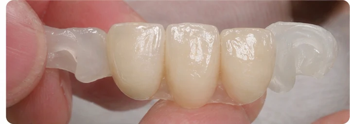Bildverlauf Denticor – Schritt 3: provisorische Versorgung – drei untere Schneidezähne (beide mittleren + seitlicher)