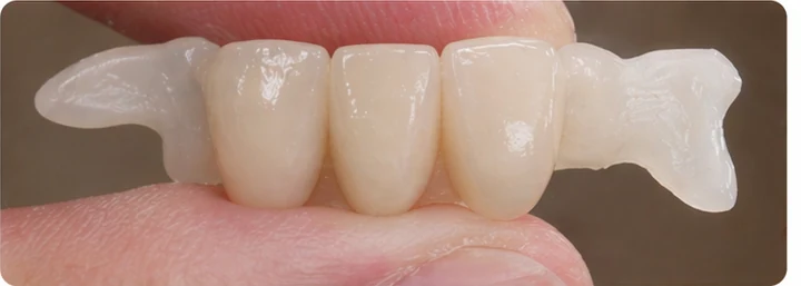 Bildverlauf Denticor – Schritt 4: provisorische Versorgung – drei untere Schneidezähne (beide mittleren + seitlicher)