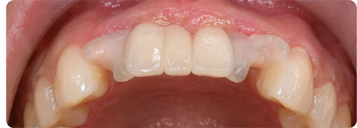 Bildverlauf Denticor – Schritt 5: provisorische Versorgung – drei untere Schneidezähne (beide mittleren + seitlicher)