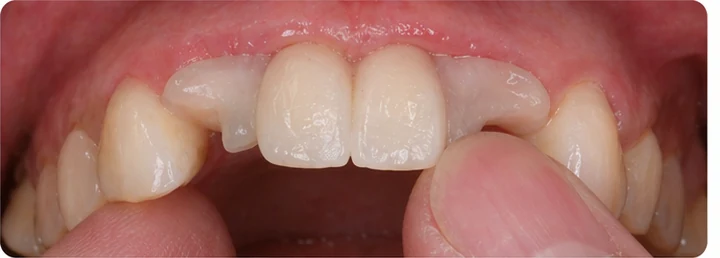 Bildverlauf Denticor – Schritt 6: provisorische Versorgung – drei untere Schneidezähne (beide mittleren + seitlicher)
