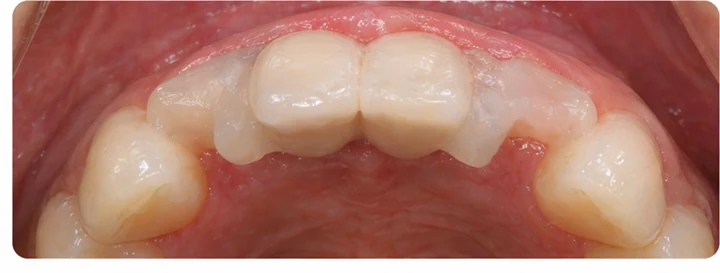 Bildverlauf Denticor – Schritt 7: provisorische Versorgung – drei untere Schneidezähne (beide mittleren + seitlicher)