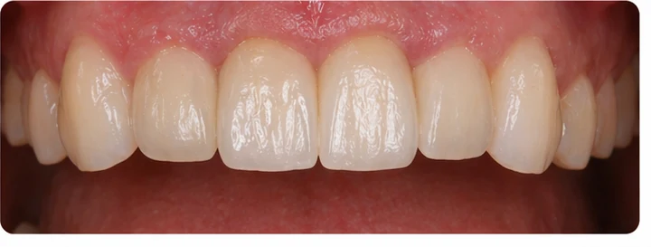 Bildverlauf Denticor – Schritt 8: provisorische Versorgung – drei untere Schneidezähne (beide mittleren + seitlicher)