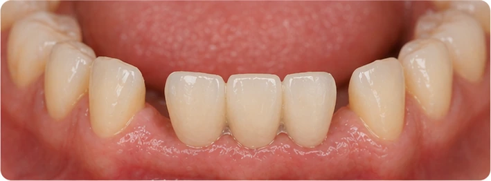 Bildverlauf Denticor – Schritt 2: provisorische Versorgung – drei untere Frontzähne