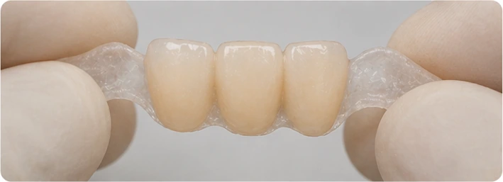 Bildverlauf Denticor – Schritt 4: provisorische Versorgung – drei untere Frontzähne