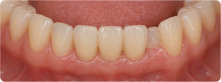 Bildverlauf Denticor – Schritt 8: provisorische Versorgung – drei untere Frontzähne