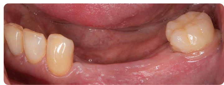 Bildverlauf Denticor – Schritt 1: provisorische Versorgung – drei untere Seitenzähne