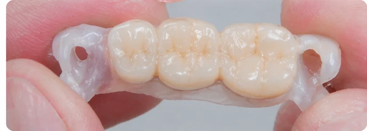 Bildverlauf Denticor – Schritt 3: provisorische Versorgung – drei untere Seitenzähne