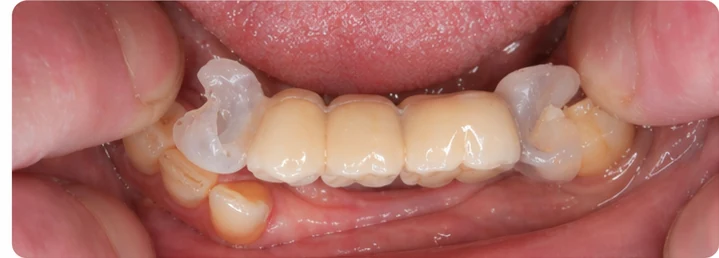 Bildverlauf Denticor – Schritt 5: provisorische Versorgung – drei untere Seitenzähne