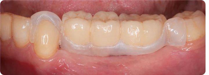 Bildverlauf Denticor – Schritt 6: provisorische Versorgung – drei untere Seitenzähne