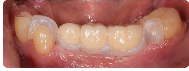 Bildverlauf Denticor – Schritt 7: provisorische Versorgung – drei untere Seitenzähne