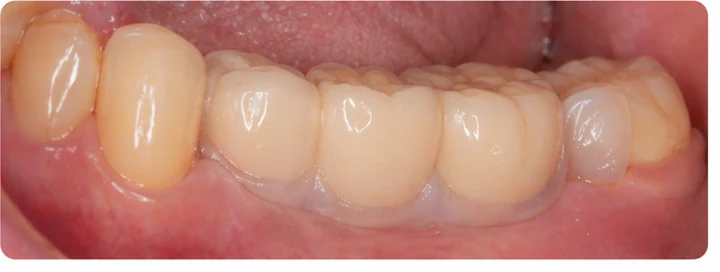 Bildverlauf Denticor – Schritt 8: provisorische Versorgung – drei untere Seitenzähne